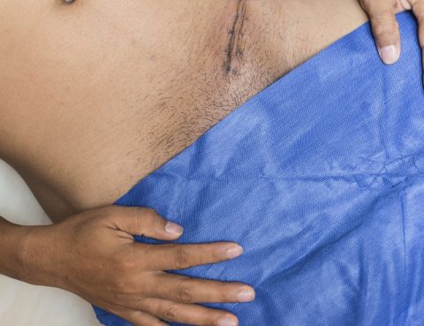 Hernia Surgery: Types, Risks, Surgery & Recovery