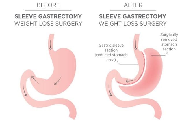 Sleeve Gastrectomy in Dallas: What to Expect & How to Prepare